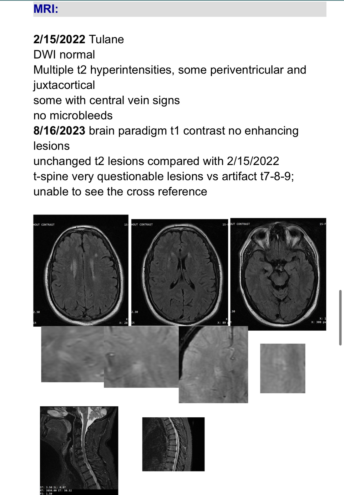 MRI brain and spine notes showing T2 hyperintensities and lesions consistent with demyelination